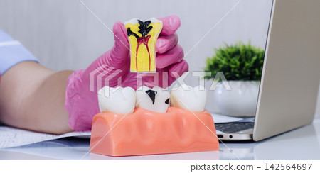 Dentist in pink medical gloves holding a cross section tooth model showing severe decay and pulpitis inflammation in a clinic. Dentist in pink medical gloves holding a cross section tooth model showing severe decay and pulpitis inflammation in a clinic. 142564697