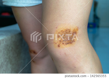 Healing knee abrasion covered dry scab antiseptic iodine after injury representing first aid wound treatment skin care recovery Healing knee abrasion covered dry scab antiseptic iodine after injury representing first aid wound treatment skin care recovery 142565355