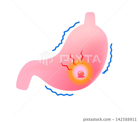 stomach pain due to stomach ulcer stomach pain due to stomach ulcer 142588911