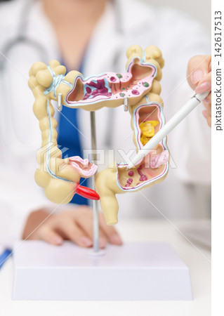 Doctor with human Colon anatomy model. Colonic disease, Large Intestine, Colorectal cancer, Ulcerative colitis, Diverticulitis, Irritable bowel syndrome, Digestive system and Healthcare concept Doctor with human Colon anatomy model. Colonic disease, Large Intestine, Colorectal cancer, Ulcerative colitis, Diverticulitis, Irritable bowel syndrome, Digestive system and Healthcare concept 142617513