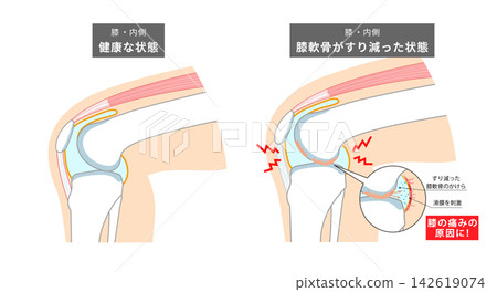 An anatomical diagram showing how the knee joint and knee cartilage wear down. An anatomical diagram showing how the knee joint and knee cartilage wear down. 142619074