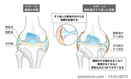 一張解剖圖,顯示了膝關節和膝關節軟骨是如何磨損的。 一張解剖圖,顯示了膝關節和膝關節軟骨是如何磨損的。 142619075