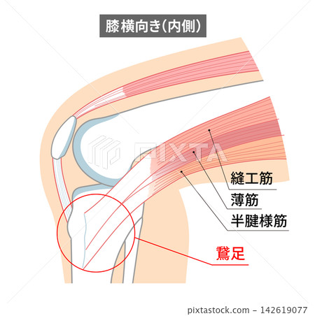 膝關節內側鵝足以及縫匠肌、股薄肌和半腱肌的解剖圖。 膝關節內側鵝足以及縫匠肌、股薄肌和半腱肌的解剖圖。 142619077