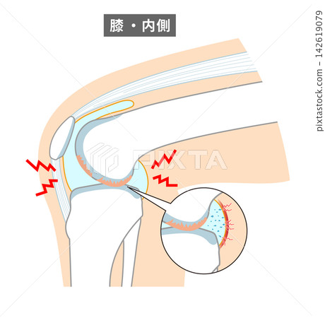 An anatomical diagram showing how the knee joint and knee cartilage wear down. An anatomical diagram showing how the knee joint and knee cartilage wear down. 142619079
