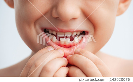 Close-up of child's mouth with missing primary teeth during natural dental development. Concept of tooth loss, permanent teeth growth and children's oral health Close-up of child's mouth with missing primary teeth during natural dental development. Concept of tooth loss, permanent teeth growth and children's oral health 142620076