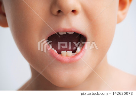 Close-up portrait of young child with a missing baby tooth, illustrating natural tooth loss and the transition from primary to permanent teeth during childhood Close-up portrait of young child with a missing baby tooth, illustrating natural tooth loss and the transition from primary to permanent teeth during childhood 142620078