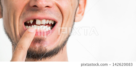 Portrait of a man with missing tooth. Dental surgery and implantation. The upper front tooth was removed. Dental problems Portrait of a man with missing tooth. Dental surgery and implantation. The upper front tooth was removed. Dental problems 142620083