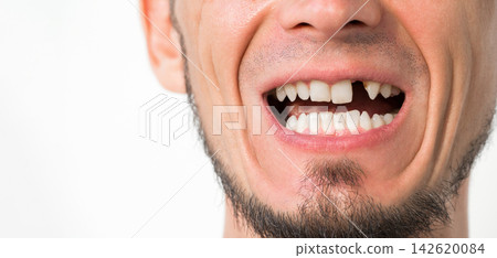 missing tooth close-up. Dental surgery and implantation. Portrait of an adult man with upper front tooth removed on white isolated background 142620084
