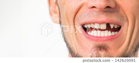 male smile with a missing upper front tooth removed. Dental surgery and dental implantation. Dental problems. Portrait of a adult man without a tooth on a white isolated background male smile with a missing upper front tooth removed. Dental surgery and dental implantation. Dental problems. Portrait of a adult man without a tooth on a white isolated background 142620091