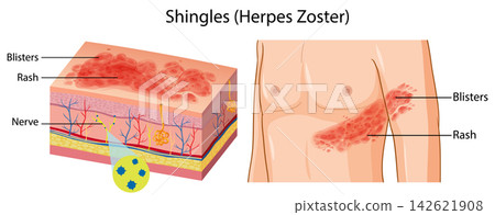 Medical Illustration of Shingles Herpes Zoster Virus on Human Skin Medical Illustration of Shingles Herpes Zoster Virus on Human Skin 142621908