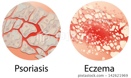 Medical Illustration Comparing Psoriasis and Eczema Skin Conditions Medical Illustration Comparing Psoriasis and Eczema Skin Conditions 142621969