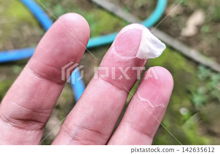 Close up of loose layer of dead skin peeling away from adult fingertip with blurry green outdoor background. Close up of loose layer of dead skin peeling away from adult fingertip with blurry green outdoor background. 142635612