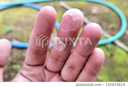 Detailed view of peeling skin on human fingers revealing dry damaged texture for dermatology medical assessment and health condition education. Detailed view of peeling skin on human fingers revealing dry damaged texture for dermatology medical assessment and health condition education. 142635614