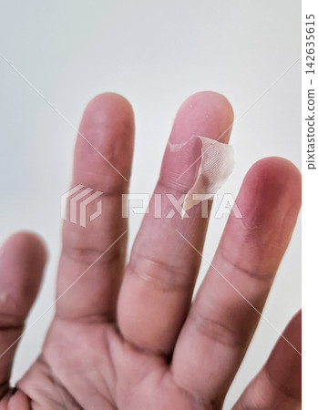 Macro detail of peeling skin on fingertip demonstrating dry epidermis surface for dermatological study health awareness and medical education. Macro detail of peeling skin on fingertip demonstrating dry epidermis surface for dermatological study health awareness and medical education. 142635615