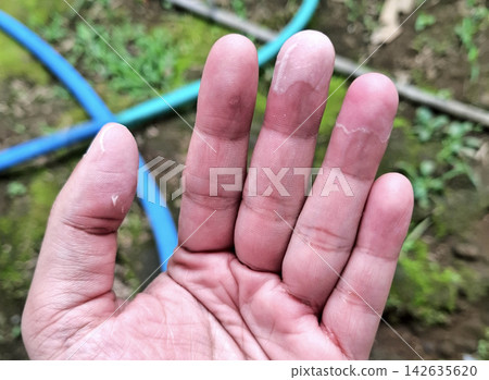 Male hand showing severe skin peeling on multiple fingertips from dry skin condition or chemical contact outdoors. Male hand showing severe skin peeling on multiple fingertips from dry skin condition or chemical contact outdoors. 142635620
