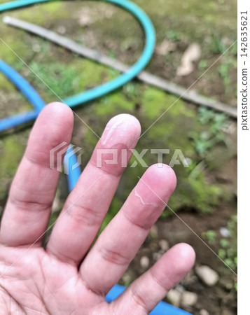 Detailed close up of flaking epidermis skin peeling off fingertips of adult male hand standing outdoors. 142635621