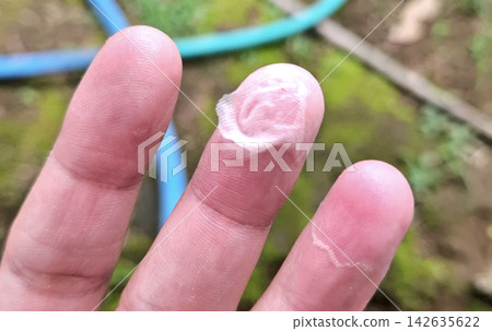 Extreme close up of epidermal skin peeling and blistering on man fingertip due to friction or dryness. Extreme close up of epidermal skin peeling and blistering on man fingertip due to friction or dryness. 142635622