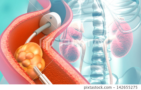 Kidney stone removal concept 142655275