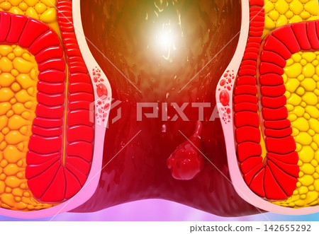 Internal hemorrhoids, piles Internal hemorrhoids, piles 142655292