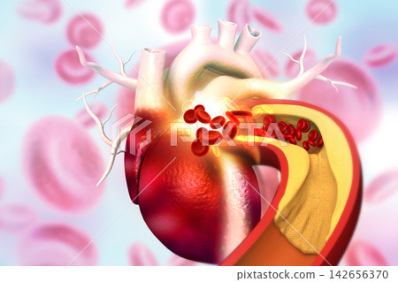 Cholesterol plaque in artery with human heart anatomy Cholesterol plaque in artery with human heart anatomy 142656370