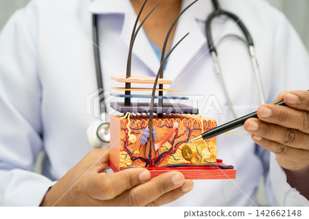 Hair transplant, Asian dermatologist doctor holding skin structure anatomy model for treatment in hospital. Hair transplant, Asian dermatologist doctor holding skin structure anatomy model for treatment in hospital. 142662148