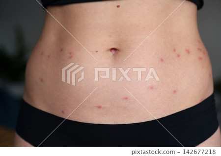 Harvest mite bites causing red itchy rash on woman abdomen 142677218