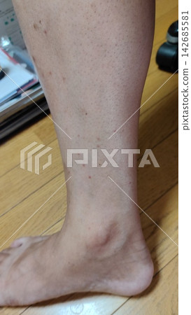 腿部因昆蟲叮咬而出現紅色皮疹和皮膚發炎(止癢藥,見叮咬前照片) 腿部因昆蟲叮咬而出現紅色皮疹和皮膚發炎(止癢藥,見叮咬前照片) 142685581