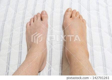 Swelling in the right foot after Achilles tendon repair surgery - comparison of left and right feet. Swelling in the right foot after Achilles tendon repair surgery - comparison of left and right feet. 142701261