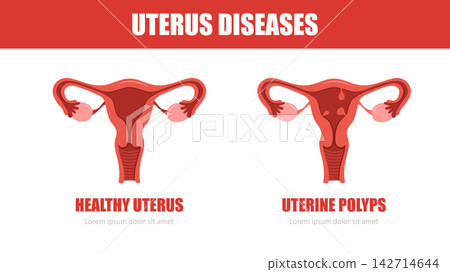 Uterus diseases. Uterine polyps concept. Medical check up. Vector illustration in flat style 142714644
