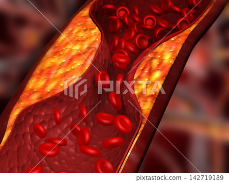 Clogged arteries, Cholesterol plaque in artery Clogged arteries, Cholesterol plaque in artery 142719189