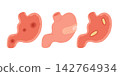 Gastritis Stomach Ulcer Illustration Set 142764934