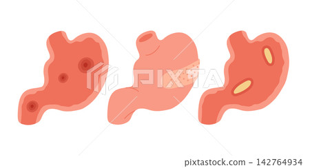 Gastritis Stomach Ulcer Illustration Set Gastritis Stomach Ulcer Illustration Set 142764934
