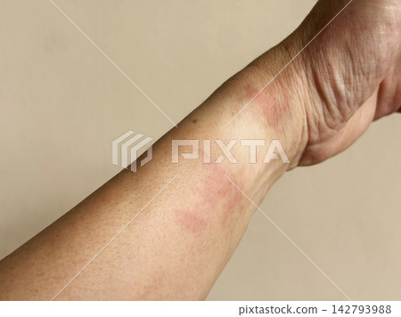 Red Allergic Skin Rash and Dermatitis on Human Wrist Red Allergic Skin Rash and Dermatitis on Human Wrist 142793988