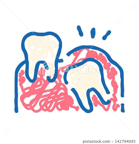 Impacted tooth causing painful gum inflammation drawing Impacted tooth causing painful gum inflammation drawing 142794085