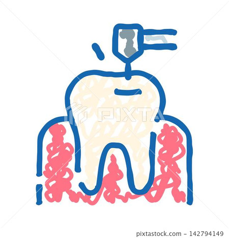 Dental drill working on a molar for treatment Dental drill working on a molar for treatment 142794149