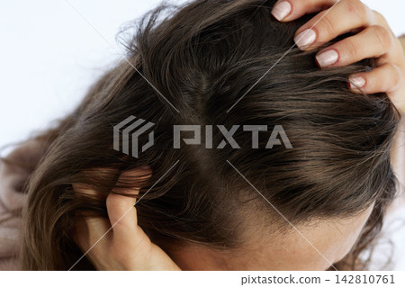 Scalp Condition Awareness - Visible Dandruff in Hair 142810761