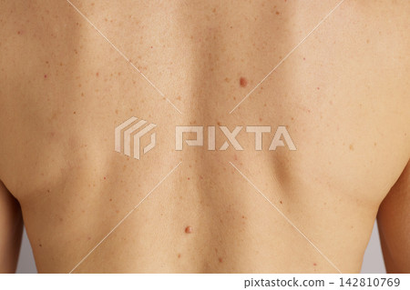 Dermatology Skin Check for Moles and Freckles 142810769