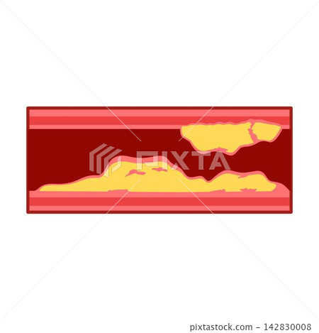 atherosclerosis atheroma plaque biology illustration atherosclerosis atheroma plaque biology illustration 142830008