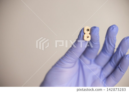 Metal dental crowns with pin placement prosthetic restoration close up Metal dental crowns with pin placement prosthetic restoration close up 142873283