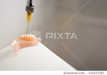 Dental prosthesis injection with carpule syringe in clinical workflow Dental prosthesis injection with carpule syringe in clinical workflow 142873361