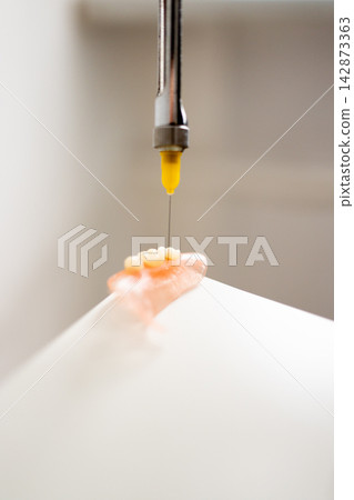 Dental prosthesis injection with carpule syringe in clinical workflow Dental prosthesis injection with carpule syringe in clinical workflow 142873363