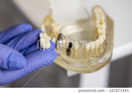 Double unit dental bridge with ceramic crowns on transparent typodont model Double unit dental bridge with ceramic crowns on transparent typodont model 142873365