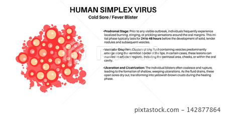 Herpes simplex virus HSV1 Herpes simplex virus HSV1 142877864