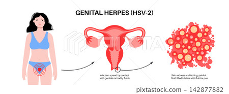 Female infection development scheme Female infection development scheme 142877882