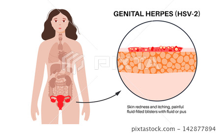 Infection skin layer scheme 142877894