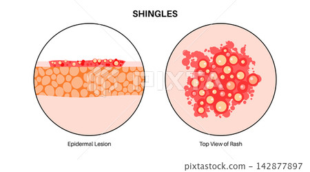Epidermal lesion cross section 142877897