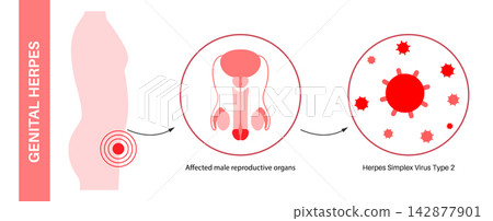 Male infection development scheme Male infection development scheme 142877901
