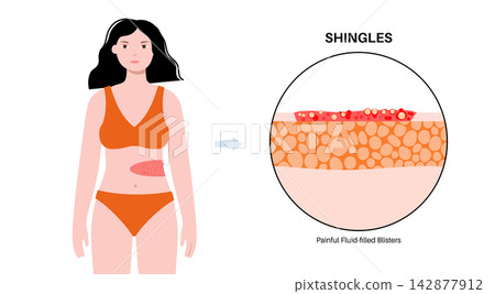 Female abdominal blister zoom Female abdominal blister zoom 142877912