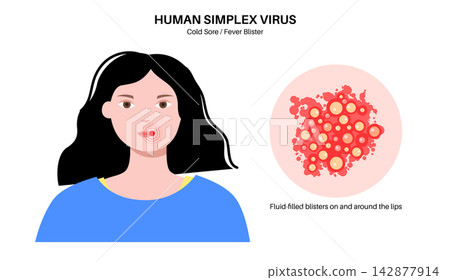 Herpes simplex virus HSV1 Herpes simplex virus HSV1 142877914