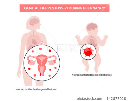 Pregnancy neonatal herpes transmission Pregnancy neonatal herpes transmission 142877928